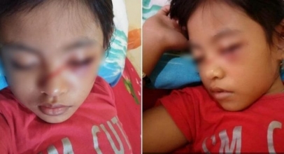 Pelajaran Bagi Orangtua, Mata Anak Ini Lebam dan Keluar Darah Akibat Kecanduan Main Ponsel
